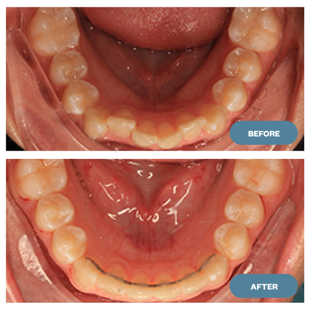 beforeafter