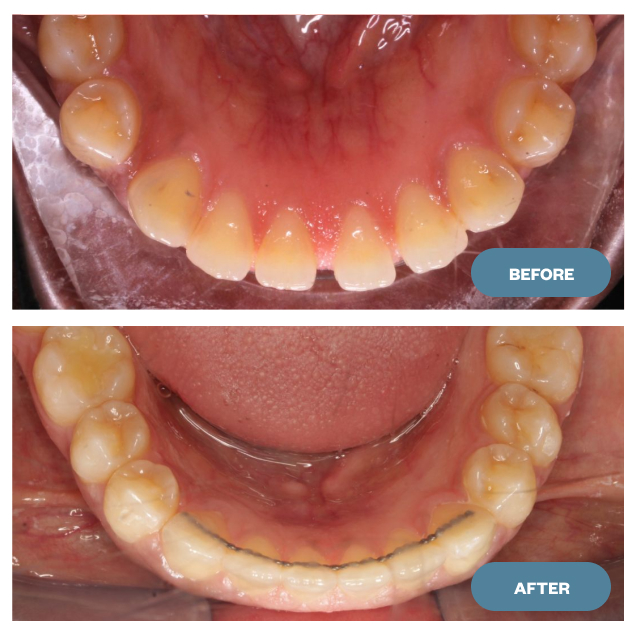 beforeafter