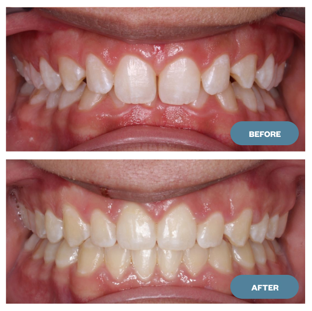 beforeafter
