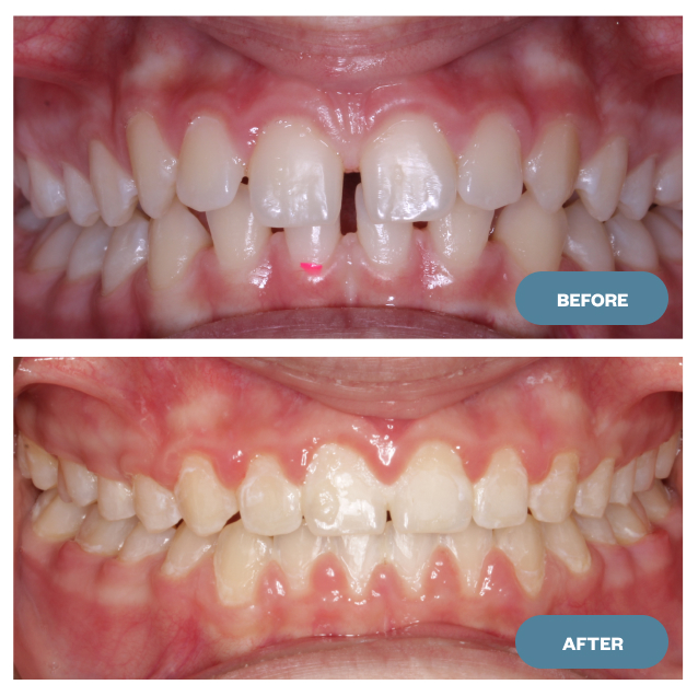 beforeafter